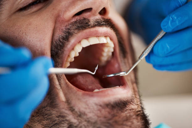 Best Emergency Treatment for Dental Infections or Abscesses in Burleson, TX